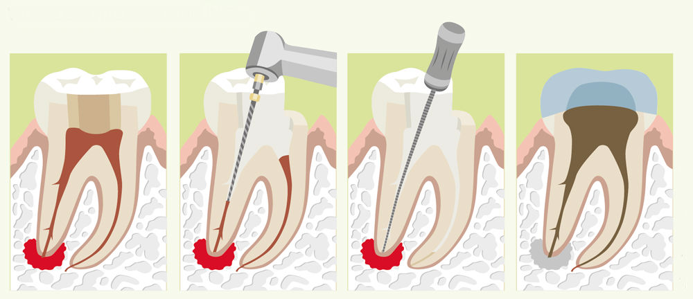 лечение гранулемы зуба с помощью медикаментов