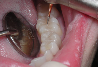 Фото 1. Лечение зубов
