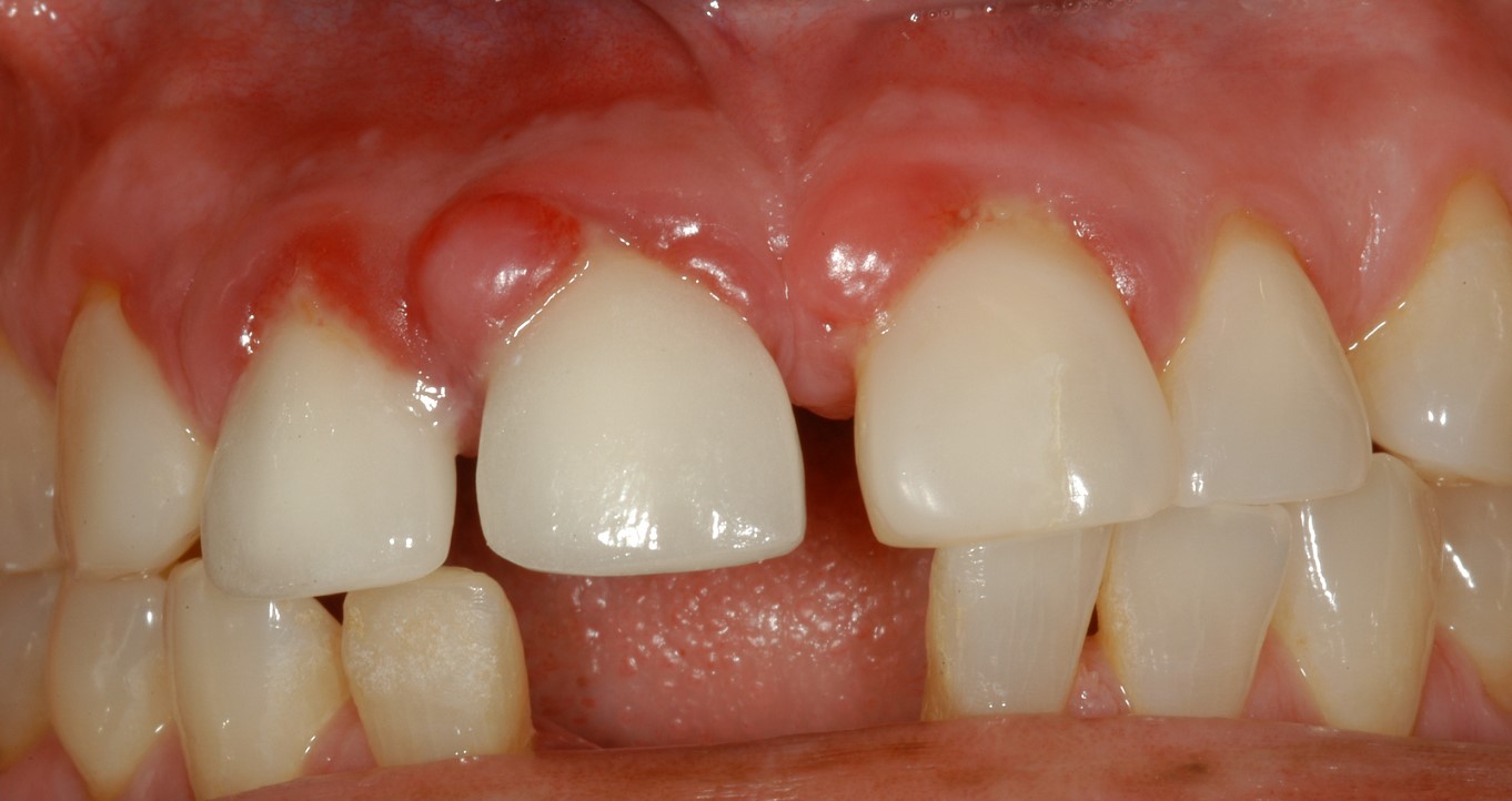 гранулема зуба фото 3