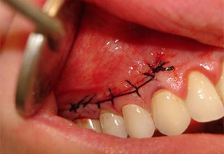 Фото 2. Цистэктомия зуба