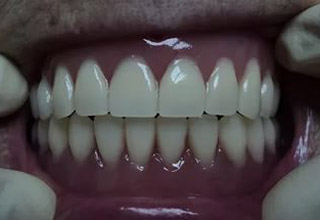Фото 4. Съемные зубные протезы