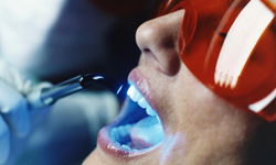 процедура лазерного отбеливания зубов: фото 1