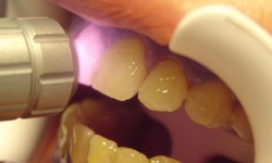 процедура лазерного отбеливания зубов: фото 3