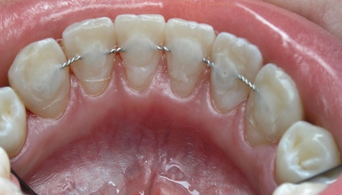 Несъемный ретейнер на нижних зубах 