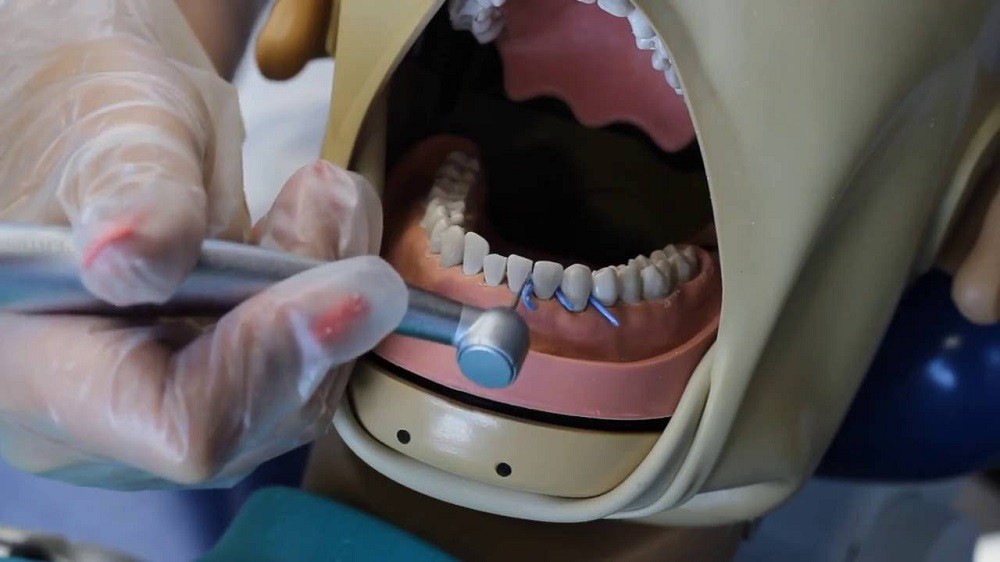 процедура сепарации зубов фото
