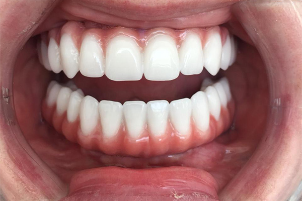 акриловый зубной протез фото 9