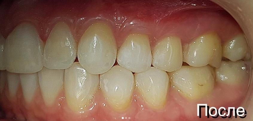 Оголились корни зубов — чем это грозит и как лечить?