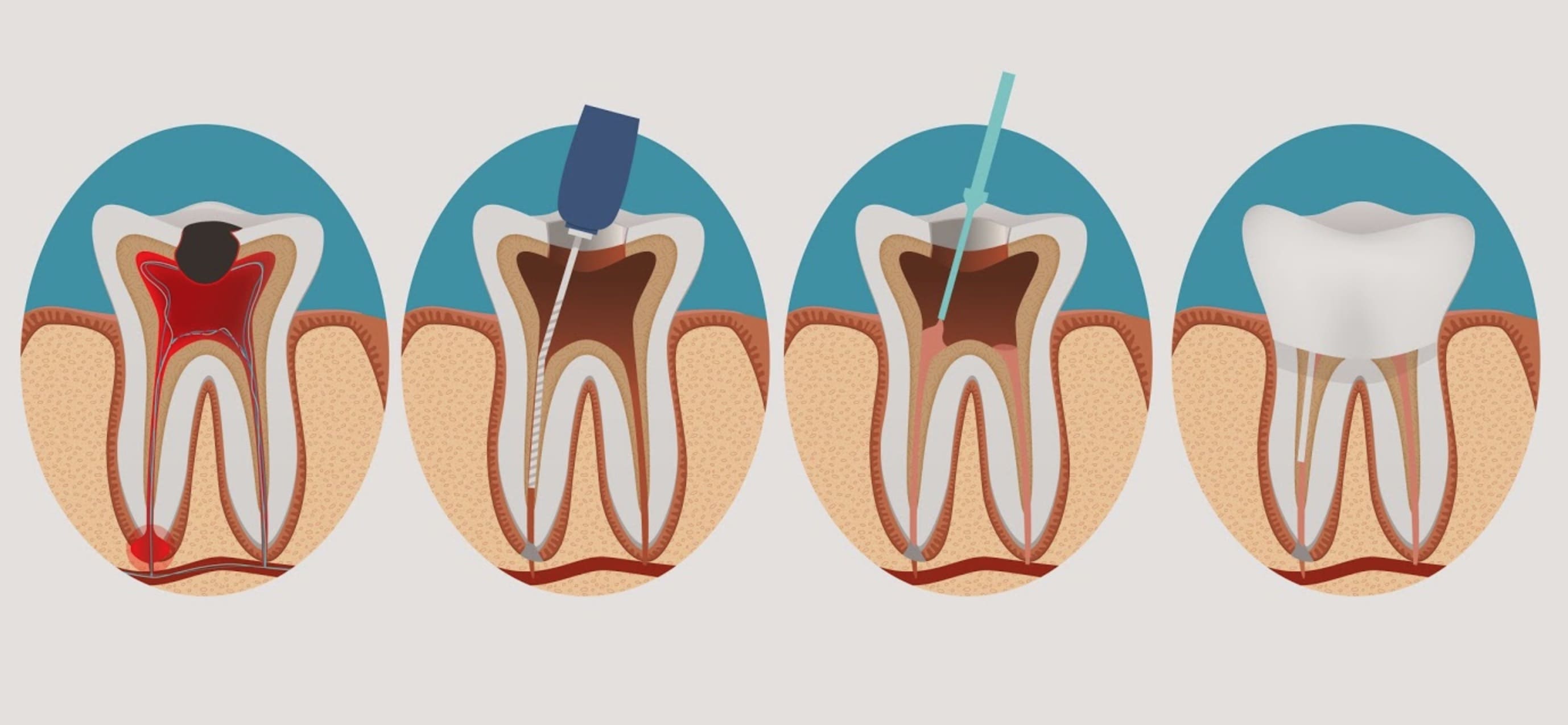 процесс депульпации зуба