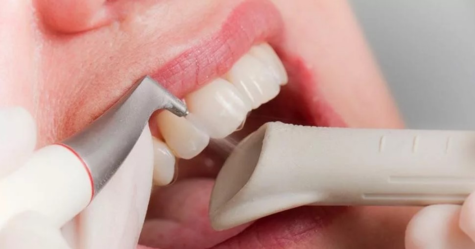 Воздушно-абразивный метод лечения дырок в зубе
