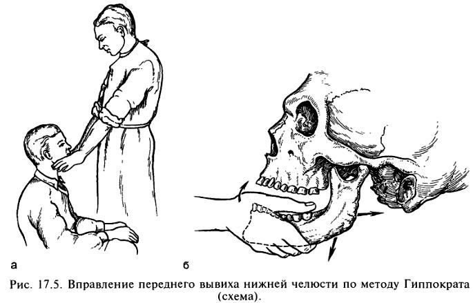 метод гиппократа при вывихе челюсти