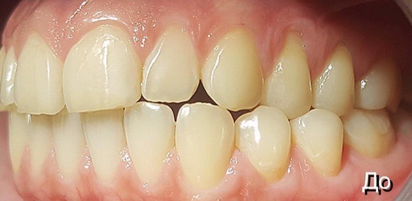 Как лечится оголение корней зубов