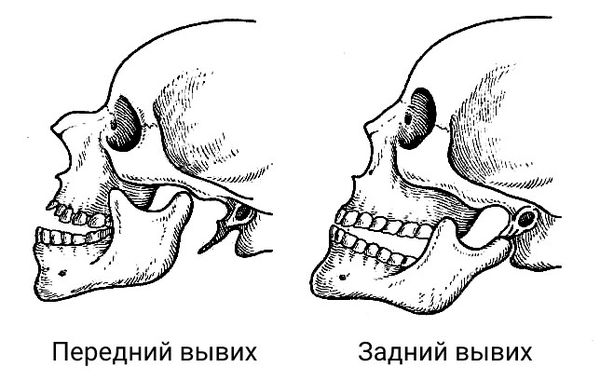 Перелом челюсти – особенности травмы для верхней и нижней ее части