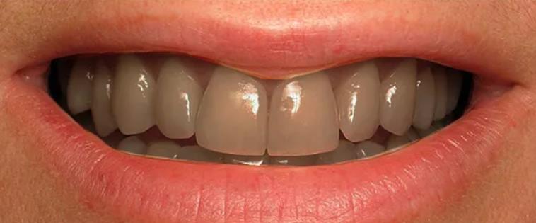 Современные методы очищения, осветления и отбеливания зубов в клинике Stomaline