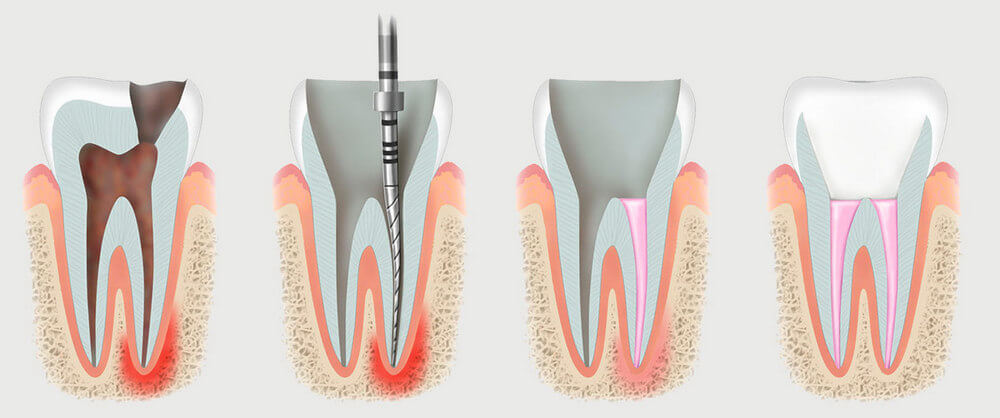 депульпация зуба этапы