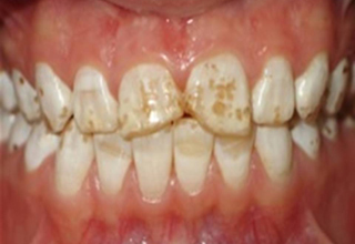 Фото 2. Некариозные поражения зубов