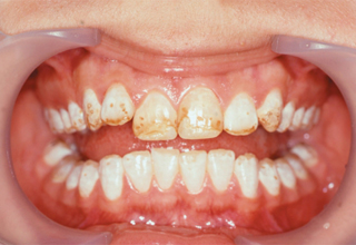 Фото 3. Некариозные поражения зубов