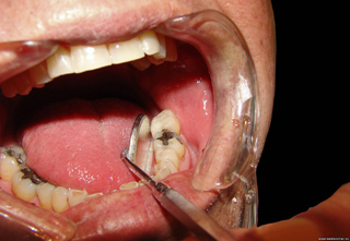 Фото 4. Некариозные поражения зубов