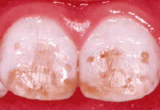 Фото 5. Некариозные поражения зубов