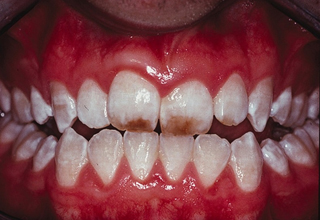 Фото 6. Некариозные поражения зубов