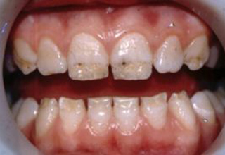 Фото 7. Некариозные поражения зубов