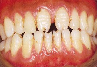 Фото 8. Некариозные поражения зубов