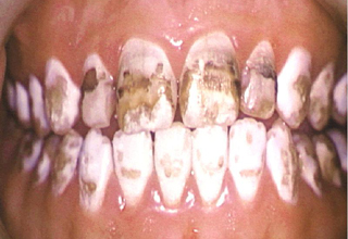 Фото 9. Некариозные поражения зубов
