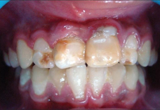 Фото 1. Некариозные поражения зубов