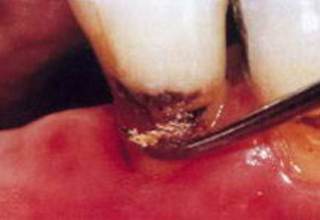 Фото 2. Кариес корня зуба