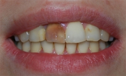 Фото 1. Реставрация зубов