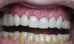 Фото 3. Реставрация зубов