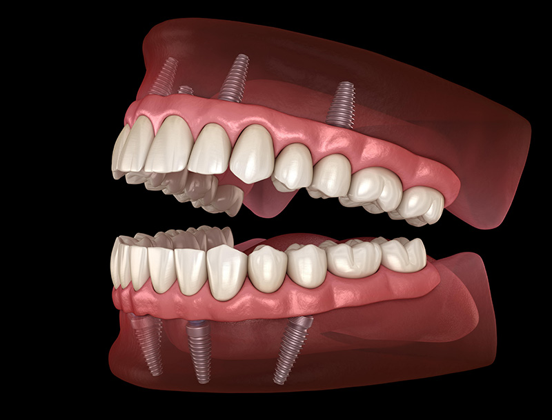 метод all-on-4 для восстановления всех зубов