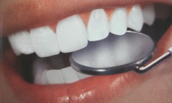 Фото 4. Зубной камень