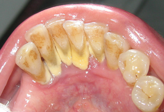 Фото 2. Зубные отложения
