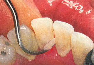Фото 3. Зубные отложения
