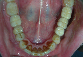 Фото 6. Зубные отложения
