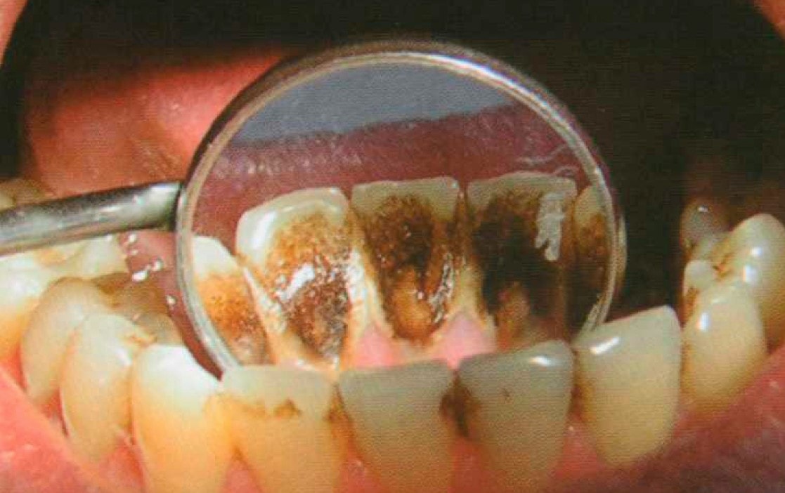 черный налет на зубах у ребенка фото