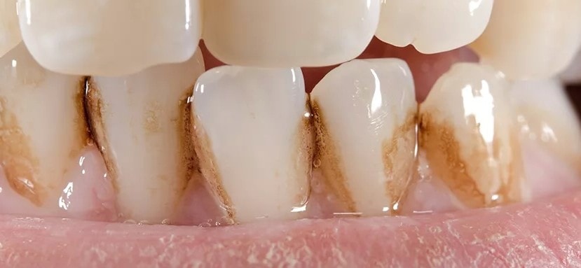 Зубной камень у детей—причины и удаление