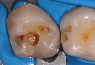 Фото 3. Лечение зубов