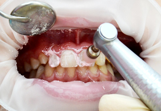 Фото 6. Лечение зубов