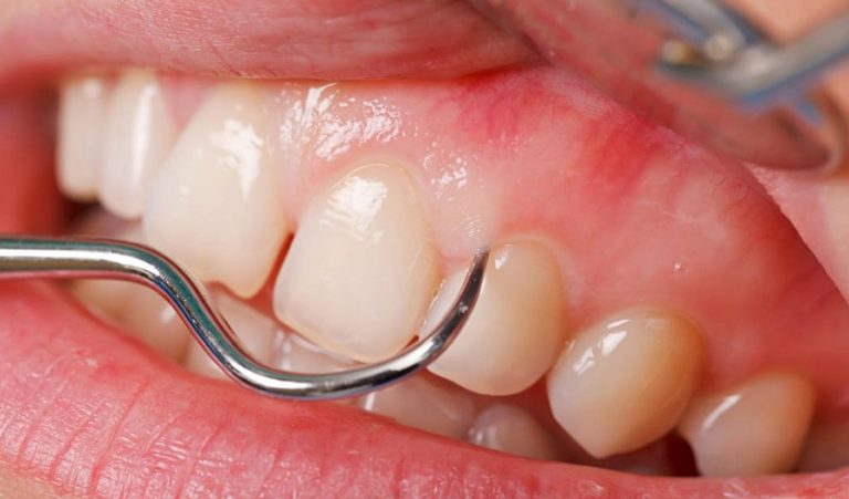 Флюс зуба — что это, симптомы и как лечить?
