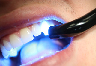 Процесс установки световой пломбы в стоматологии Москвы
