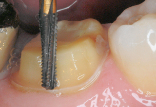 Фото 1. Препарирование зубов