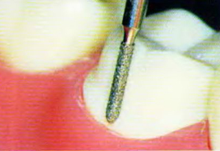 Фото 2. Препарирование зубов