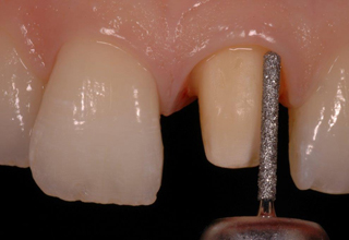 Фото 5. Препарирование зубов