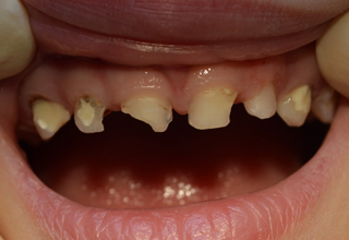 Фото 2. Разрушенные зубы