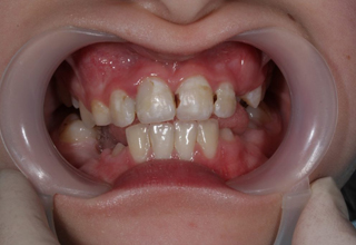 Фото 7. Разрушенные зубы