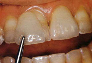 Фото 5. Восстановление зубов
