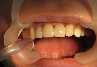 Фото 9. Восстановление зубов