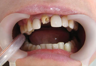 Фото 12. Восстановление зубов