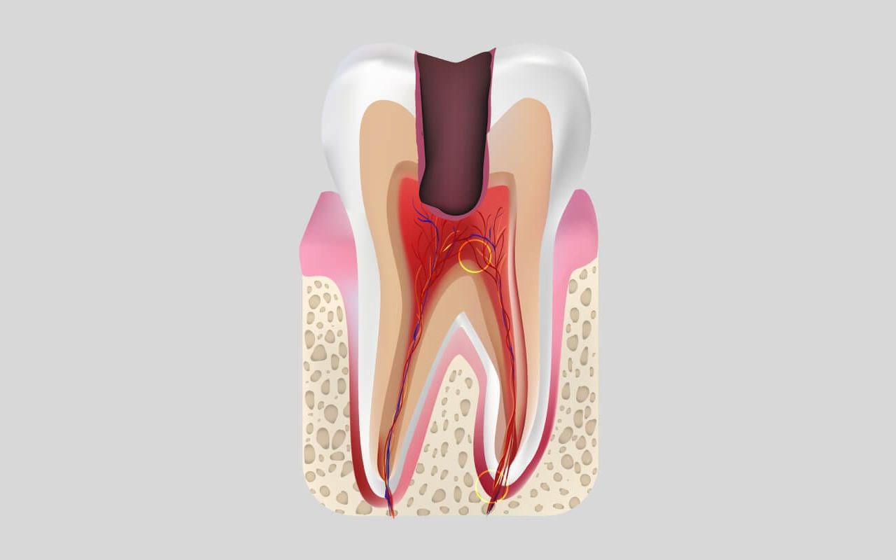 пульсирующая зубная боль под пломбой